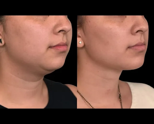 Best Double Chin Removal Surgeons in Dubai: Must-Know Precautions