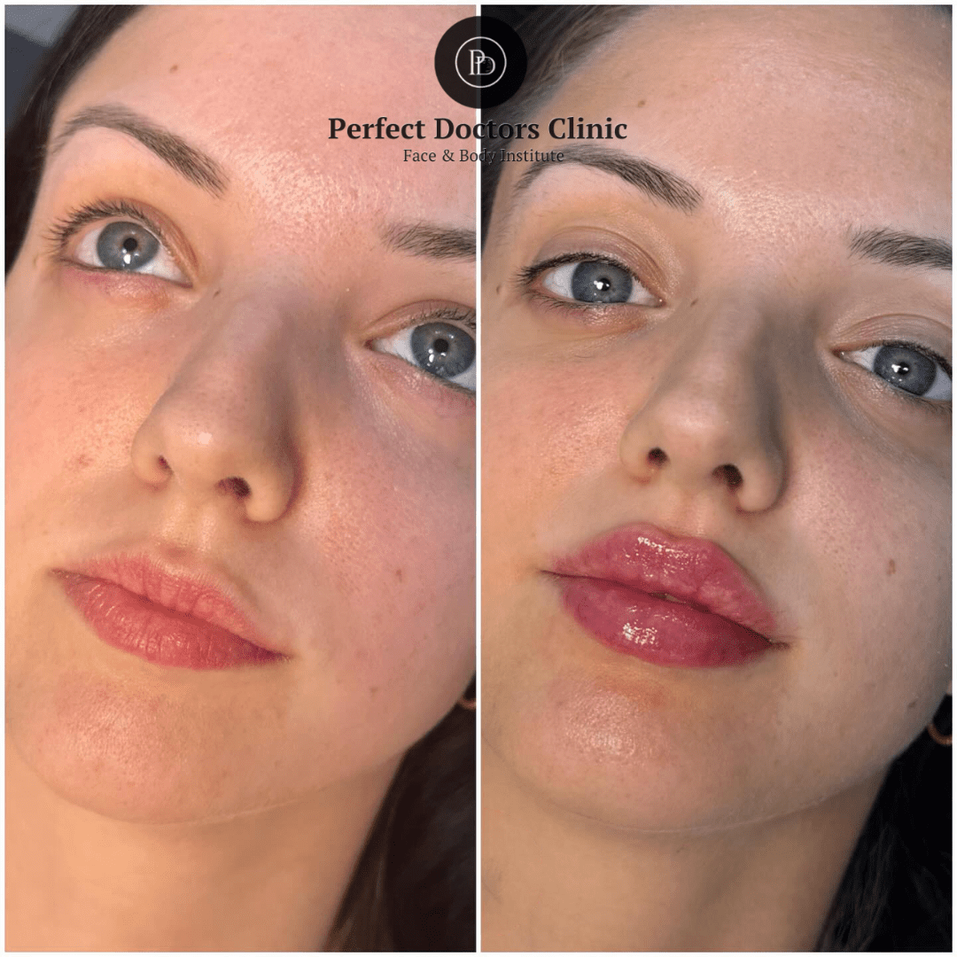 Juvederm Steps Explained by the Best Aesthetic Clinic in Dubai