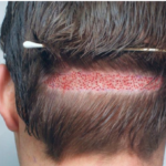 FUE Hair Transplant Pakistan