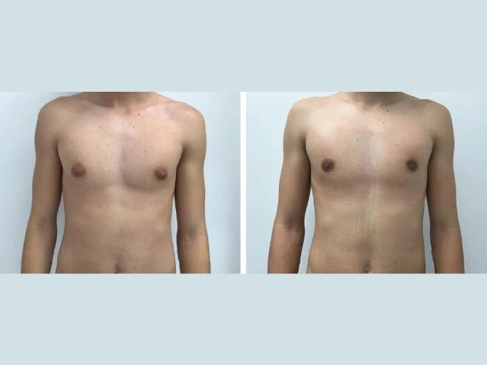 What to Expect From the Best Gynecomastia Surgeons in dubai