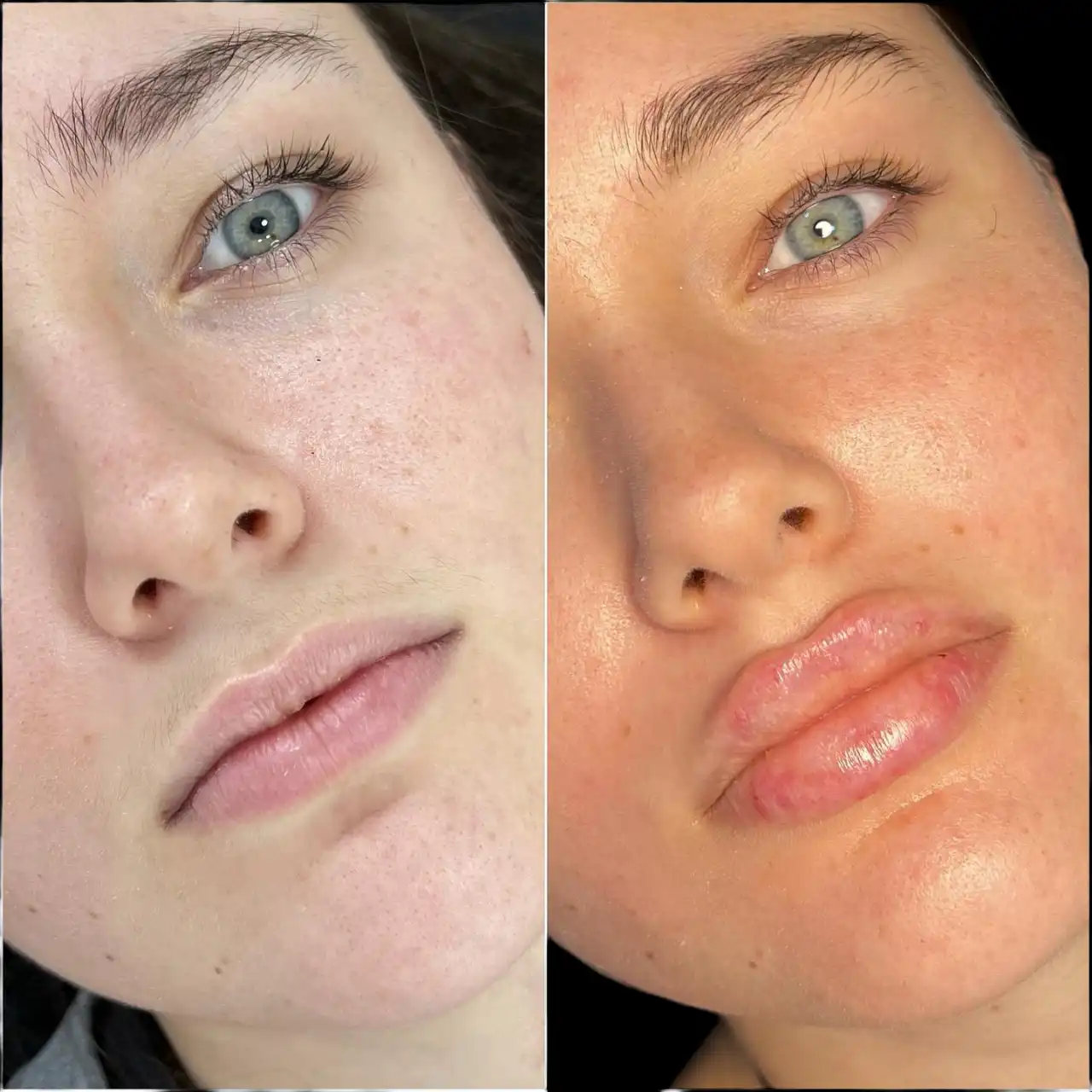Best Doctors in dubai for Fillers for Confidence-Boosting Results
