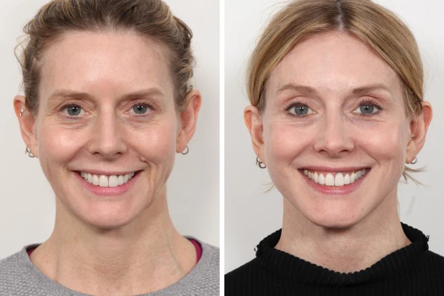 Best Doctors in dubai for Thread Lift Expert Non-Surgical Care