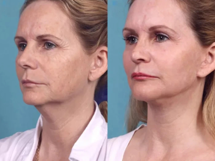 Best Doctors in dubai for Chemical Peel Treatment Expectations