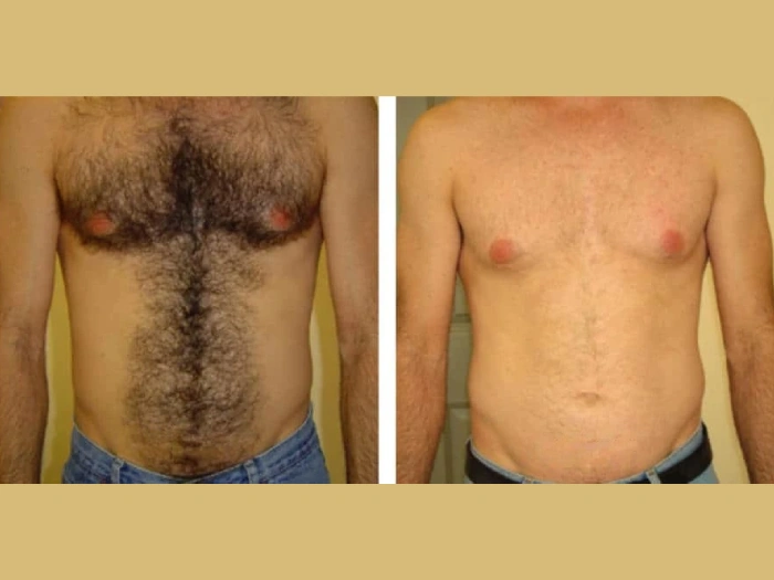 Best Aesthetic Clinic in dubai: Offer Affordable Electrolysis Laser hair removal Treatments