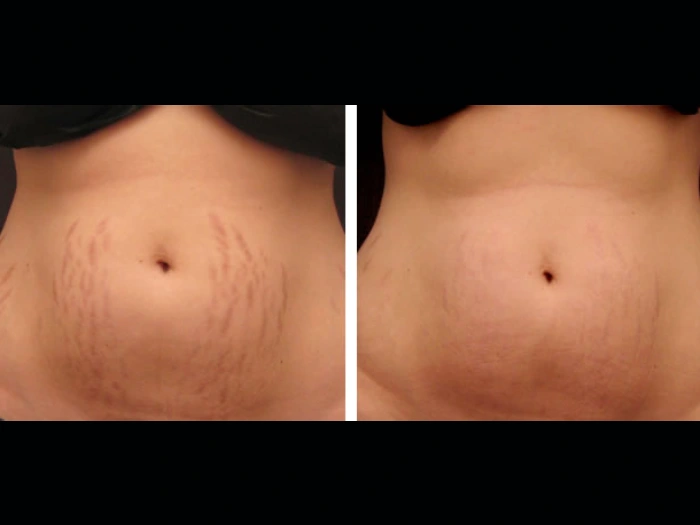 Client Favorites: Radiofrequency (RF) Microneedling Best Doctors in Dubai