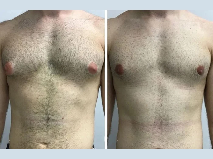 What to Expect When Choosing the Best Gynecomastia Surgeon in Dubai