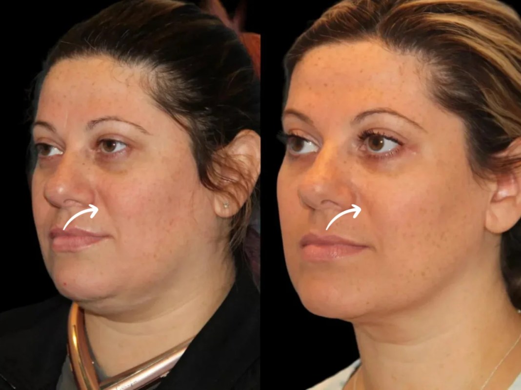 Best Doctors in Dubai for Certified Sculptra Injections
