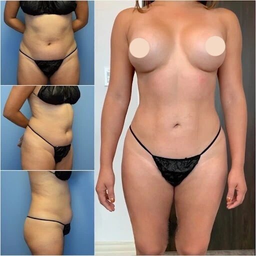 Sculpt Your Body with the Best Body Contouring Surgeons in Dubai
