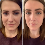 Prp Treatment in Dubai