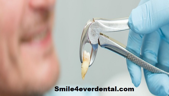 Relieve Puffiness After Tooth Removal Quickly