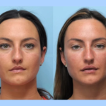 Facial Rejuvenation with Thread Lift Performed by the Best Plastic Surgeon in Dubai