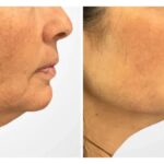 Thread Lift Treatment in Dubai Enhances Natural Facial Firmness and Definition