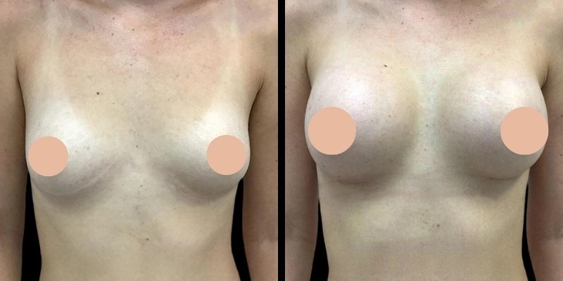 Breast Augmentation and Age Considerations by the Best breast Enlargement Surgeon in dubai
